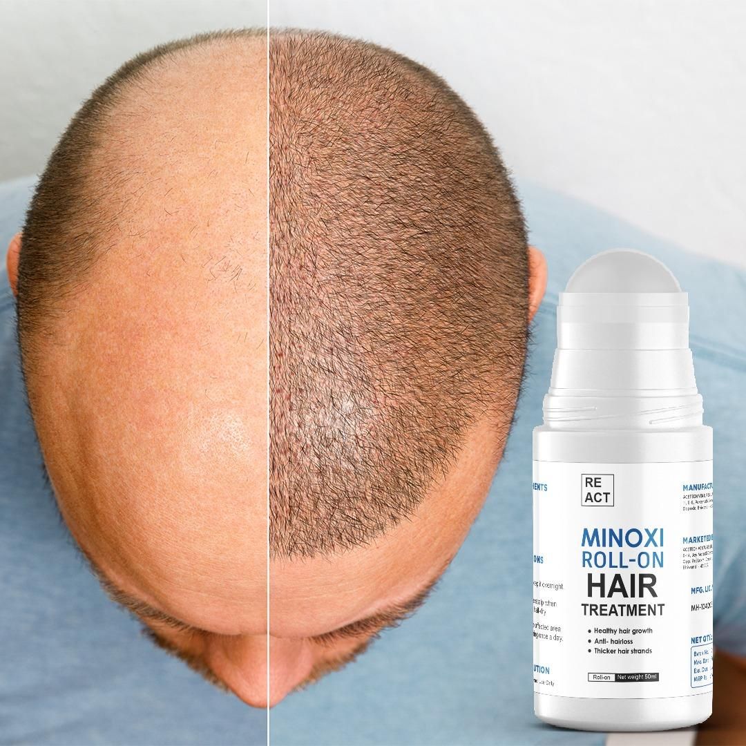 Minoxi Roll-On Hair Growth Serum For Women & Men