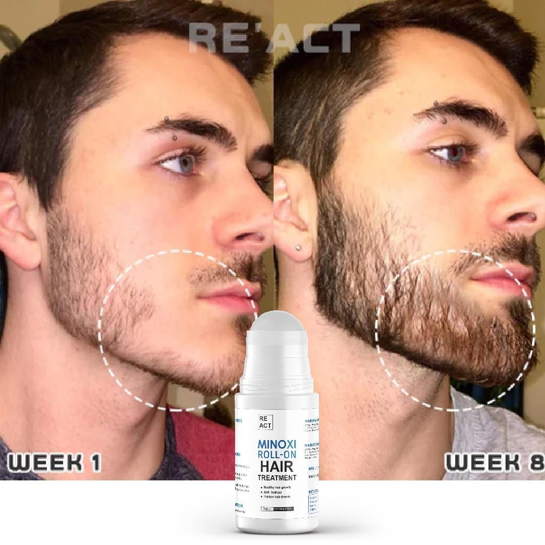 Minoxi Roll-On Hair Growth Serum For Women & Men