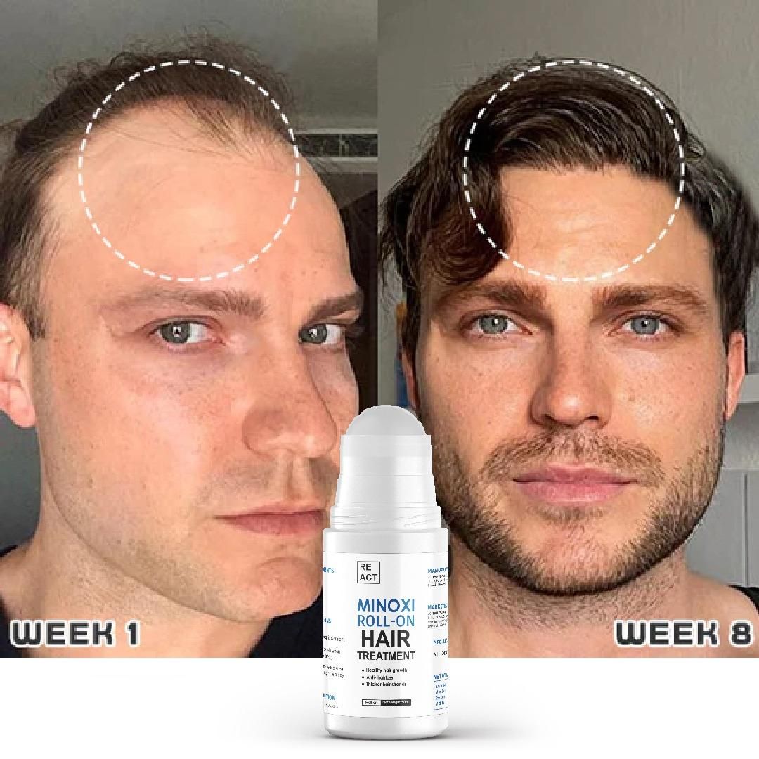 Minoxi Roll-On Hair Growth Serum For Women & Men