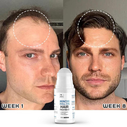 Minoxi Roll-On Hair Growth Serum For Women & Men